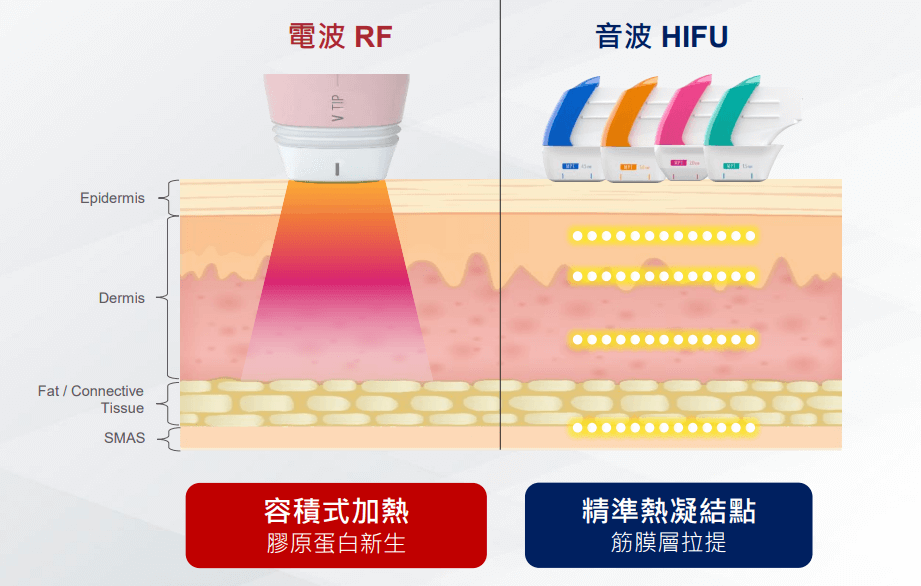 海芙音電波比較 海芙音波和海芙電波的差異 到底該打音波還是電波